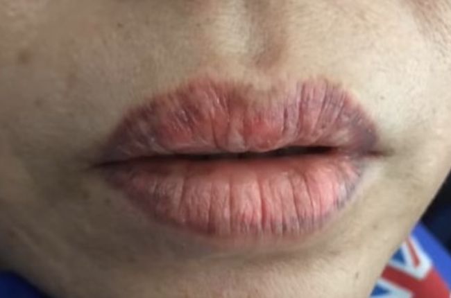 Mực xăm kém chất lượng khó bám vào thượng bì da, dễ gây viêm nhiễm và khiến màu môi bị loang lổ, không đều màu.