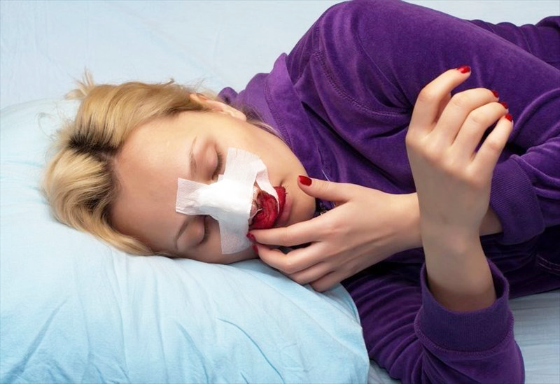Mũi sau mổ chưa ổn định, cần nẹp và tránh va chạm để không bị lệch dáng.