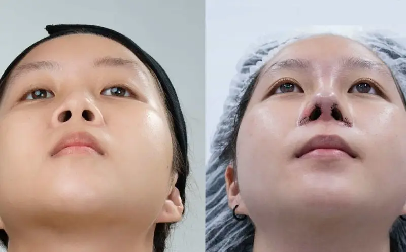 Sau phẫu thuật cánh mũi, phản ứng viêm tự nhiên chỉ gây ê căng nhẹ, dễ kiểm soát bằng thuốc.