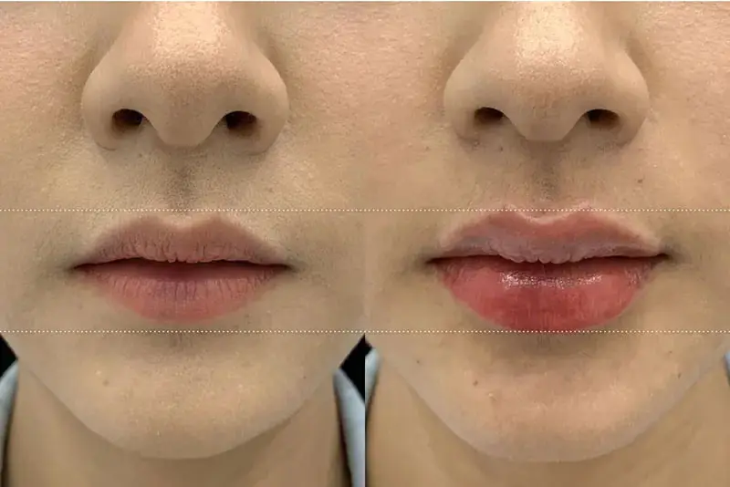 Từ 18 tuổi trở lên, bạn đã đủ điều kiện pháp lý để tiêm filler, nhưng chuyên gia vẫn khuyên nên cân nhắc kỹ vì cấu trúc mặt chưa thực sự ổn định hoàn toàn.
