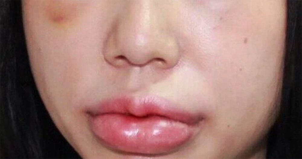 Filler kém chất lượng chứa tạp chất dễ bị vón cục, khó tan hoặc không tan vĩnh viễn, gây biến dạng và sưng viêm kéo dài.