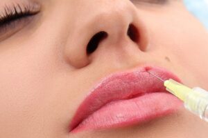 Bao nhiêu tuổi được tiêm filler môi? Khuyến nghị y khoa