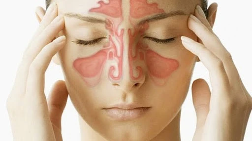Viêm xoang có nên nâng mũi không: điều kiện an toàn và thời điểm