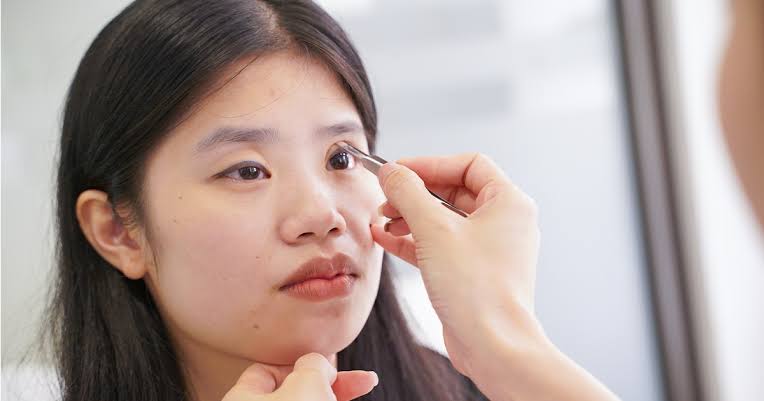 Sửa mí hỏng phức tạp hơn nhiều so với lần đầu do cấu trúc mô bị tổn thương, đòi hỏi thời gian chờ sẹo mềm trước khi can thiệp.