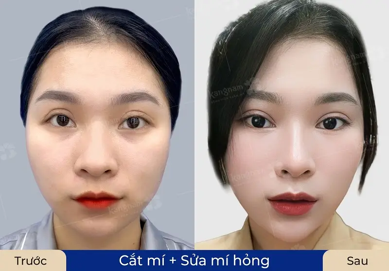 Nên đợi từ 3–6 tháng sau khi cắt mí hỏng để mô sẹo mềm và nếp mí ổn định trước khi phẫu thuật sửa lại.