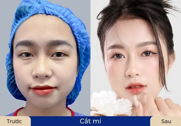 Bước đo vẽ tỉ mỉ theo cử động mắt giúp xác định chính xác đường mí mới, tránh tình trạng lệch mí hay lấy da dư quá tay.