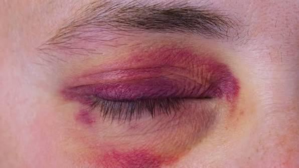 Bầm tím quanh mắt sau nâng mũi thường giảm dần sau 10–14 ngày do cơ chế ứ đọng máu dưới mô mỏng.