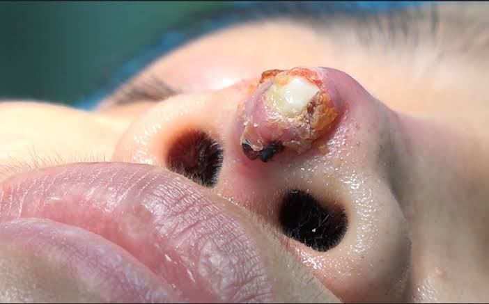 Dấu hiệu nhiễm trùng sau nâng mũi: phân biệt sưng thường hay sưng viêm
