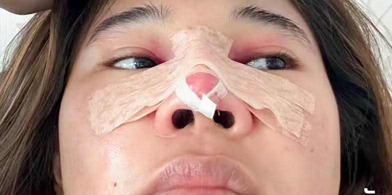Nhiễm trùng sau nâng mũi thường do vô khuẩn kém, kỹ thuật đặt sụn sai sót, vật liệu lỗi hoặc chăm sóc sai cách.