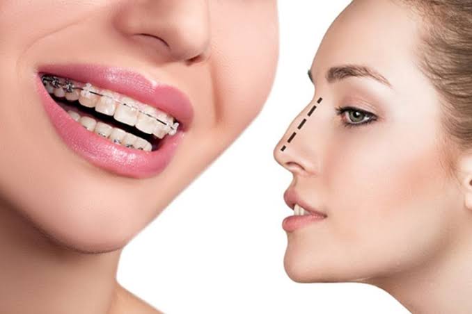 Niềng răng hoàn toàn thực hiện được sau nâng mũi khi vùng mũi đã lành thương và ổn định phom dáng.