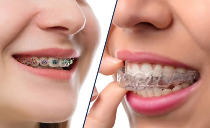 Nâng mũi rồi có niềng răng được không? Thời gian chờ an toàn