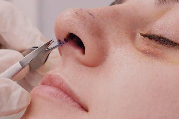 Rút ống nâng mũi bắt buộc thực hiện tại cơ sở y tế để tránh chảy máu, rách niêm mạc và nhiễm trùng.