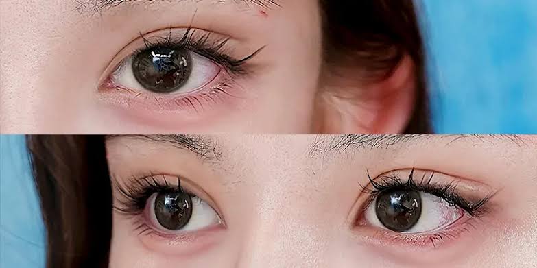 Chọn cơ sở có giấy phép, bác sĩ chuyên khoa tư vấn trực tiếp và quy trình vô khuẩn để đảm bảo kết quả.