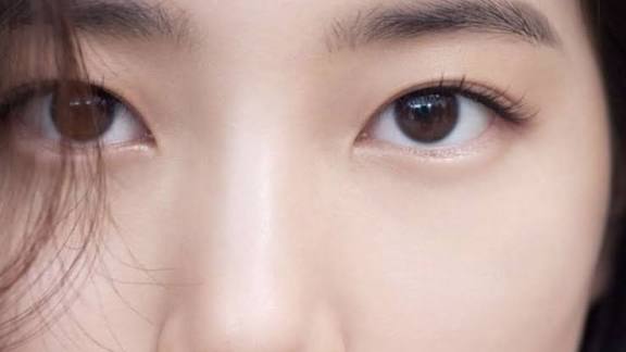 Cắt mí cánh tiên: chi phí và thời gian lành bao lâu?