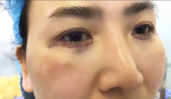 Cắt mí dưới bị lật mí: nguyên nhân và cách xử lý an toàn