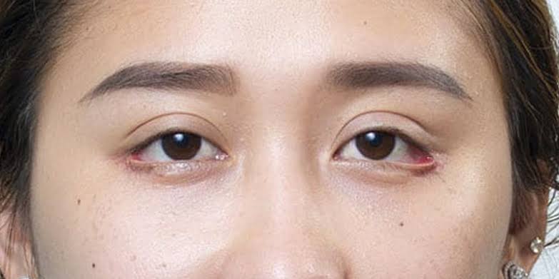 Lật mí làm mắt nhắm không kín, làm tăng nguy cơ khô giác mạc, viêm nhiễm và suy giảm thị lực kéo dài.