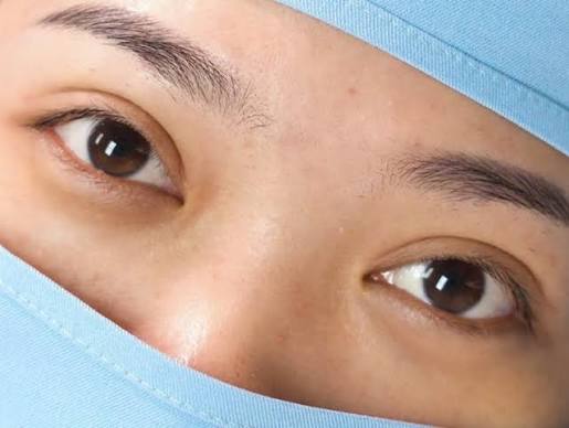 Mí mắt cắt chỉ sau 5–7 ngày, giảm sưng rõ từ 1–2 tuần và vào form đẹp tự nhiên trọn vẹn sau 3–6 tháng.