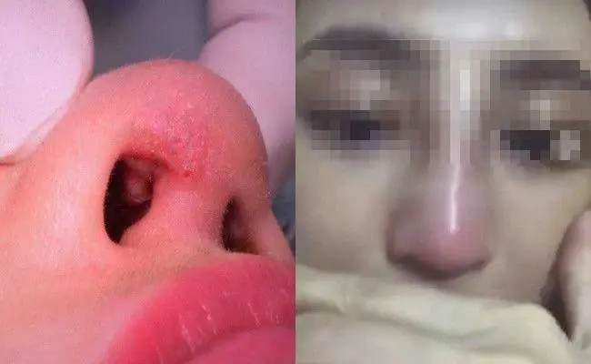 Dấu hiệu nhiễm trùng sau nâng mũi gồm sưng đau kéo dài, chảy mủ hôi, da nóng đỏ và sốt toàn thân.