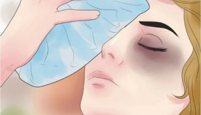 Chườm ấm và massage nhẹ quanh mắt giúp tan máu bầm, tuyệt đối không đè lên sống mũi và nẹp mổ.