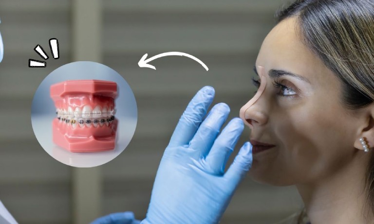 Cần thông báo chi tiết thời điểm phẫu thuật, phương pháp và vật liệu nâng mũi cho bác sĩ chỉnh nha trước điều trị.